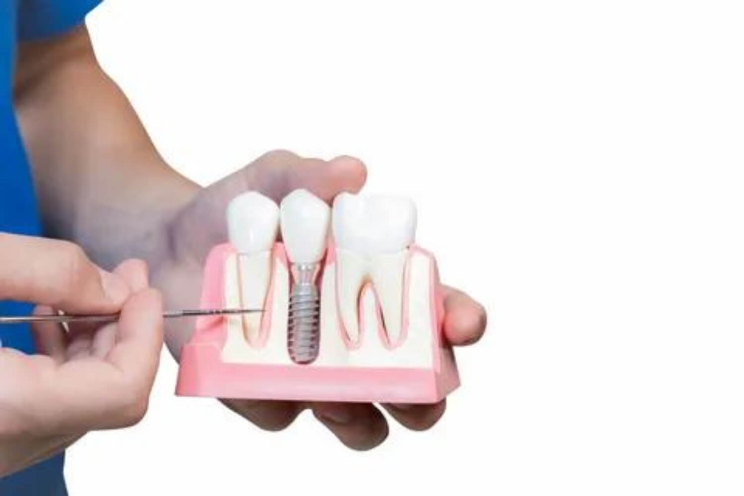 Guided Implant Surgery