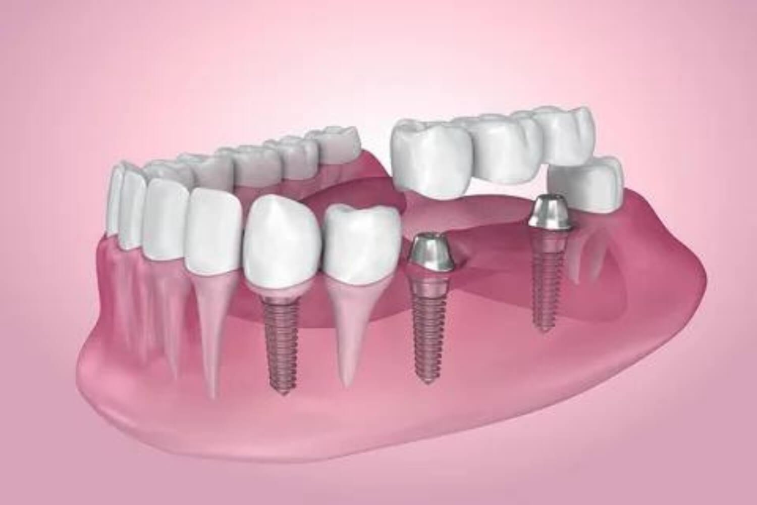 Dental Implants