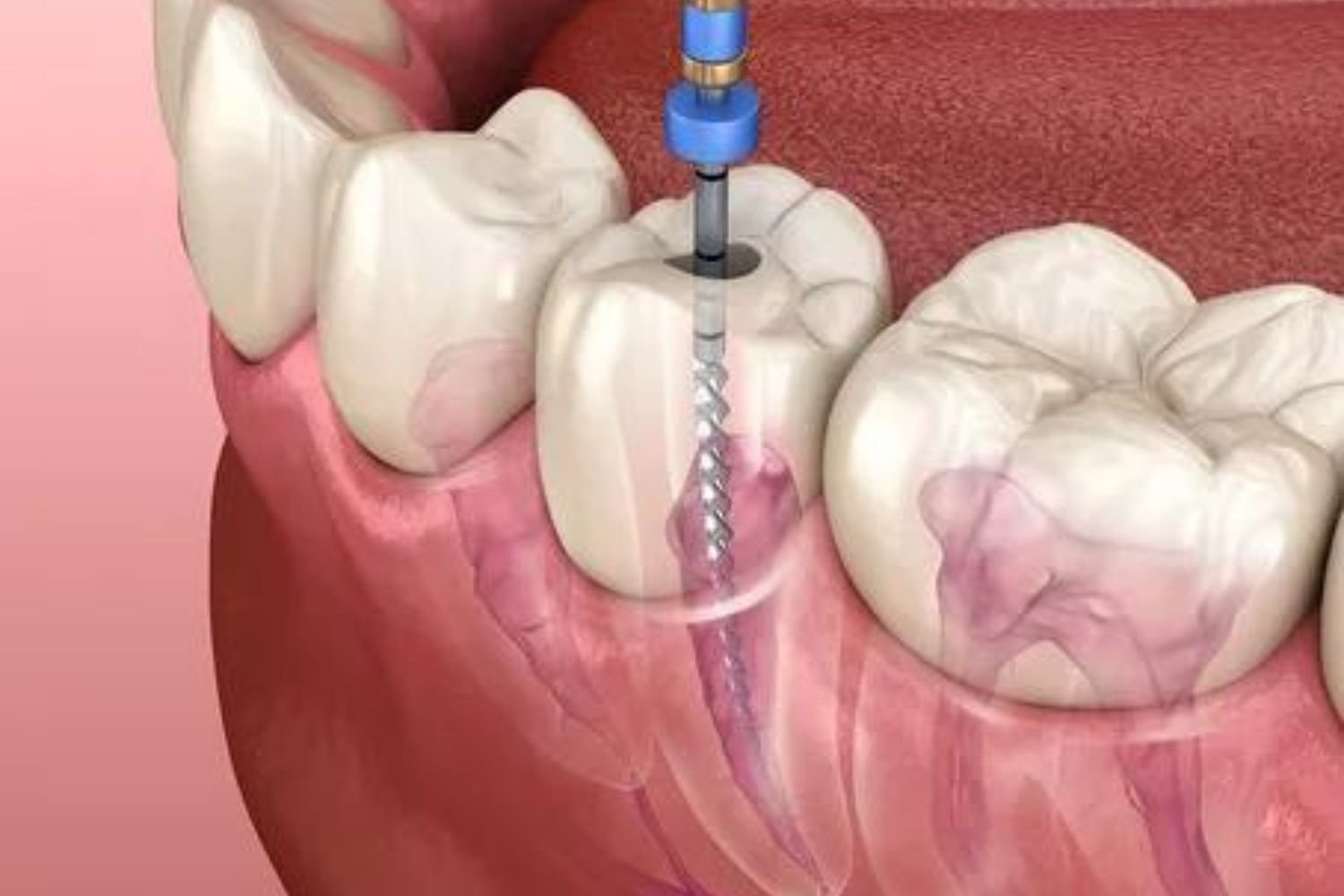 Advanced Microscopic Root Canal Treatment Centre